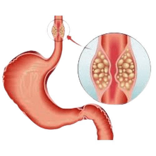 Esophagus Cancer