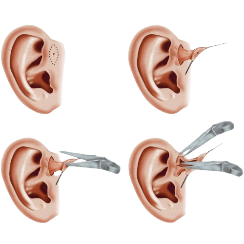 Excision of Preauricular Sinus