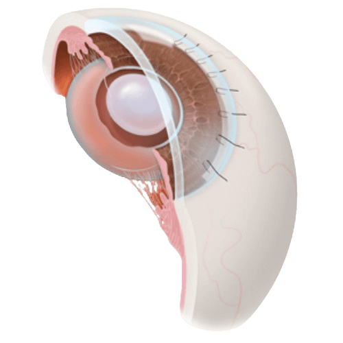 Extracapsular Cataract Extraction