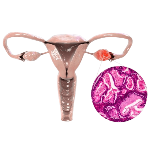 Fallopian Tube Cancer