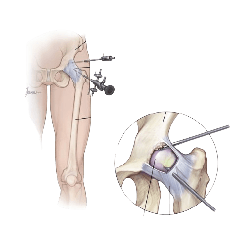 Femoroacetabular Impingement Surgery (FAI)