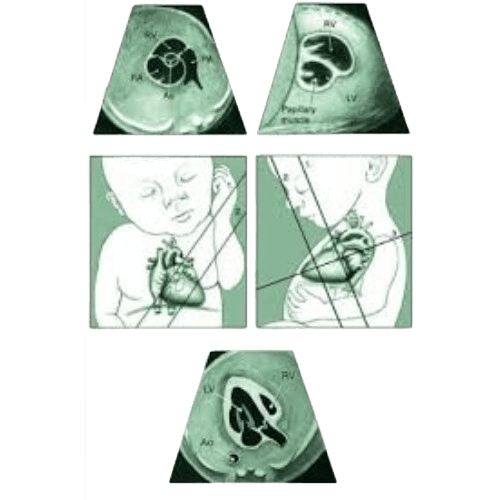 Fetal Echo