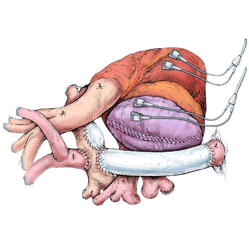 Fontan Conversion Surgery