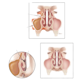 Functional Endoscopic Sinus Surgery - FESS