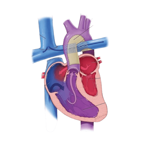 Glenn Procedure