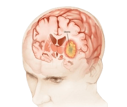 Gliomas