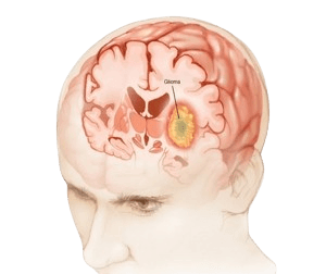 Gliomas