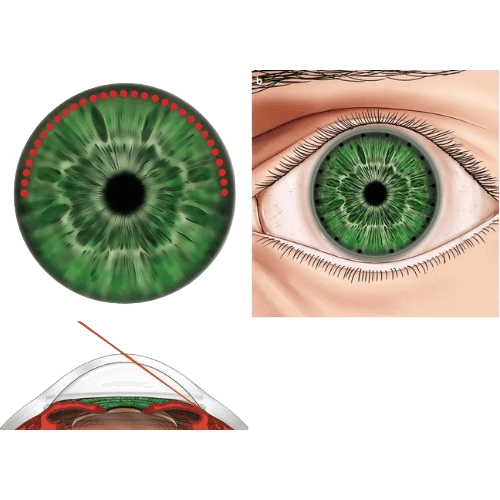 Gonioplasty (Iridoplasty)