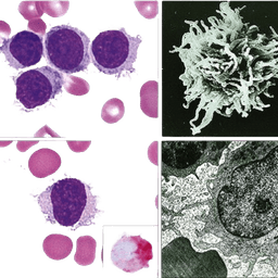 Hairy Cell Leukemia-HCL