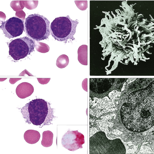 Hairy Cell Leukemia-HCL