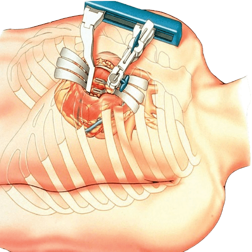 AORTOKORONARNOE SHUNTIROVANIE