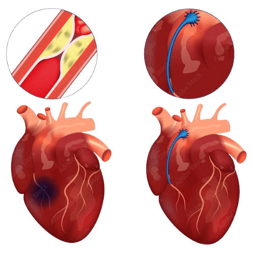 Heart Bypass Surgery