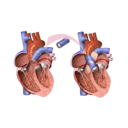 Heart Double Valve Replacement