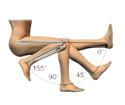 High-Flex Knee Replacement