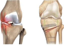 High Tibial Osteotomy