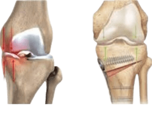 High Tibial Osteotomy