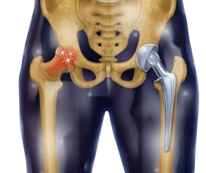 Hip Replacement Surgery