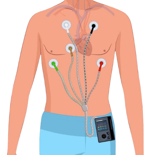 Holter Monitoring (24 hours)