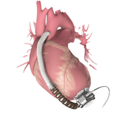 HVAD (HeartWare Ventricular Assist Device)
