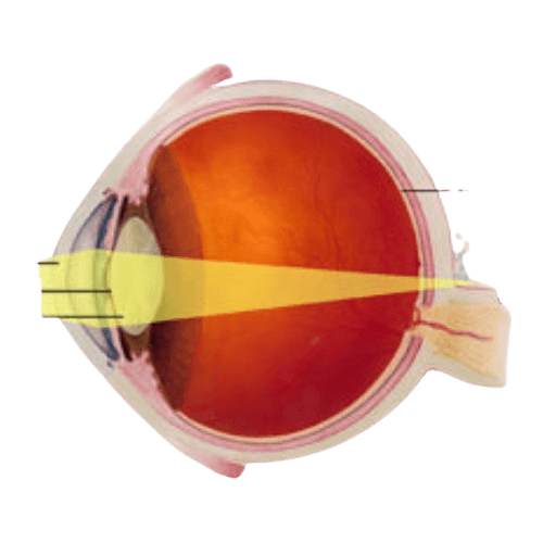 Hyperopia (Farsightedness)