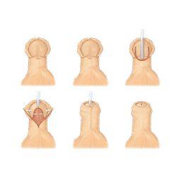 Hypospadias Repair Surgery