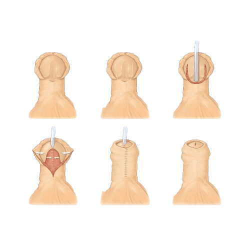 Hypospadias Repair Surgery