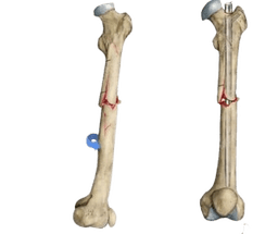 Internal Fixation of Fractures