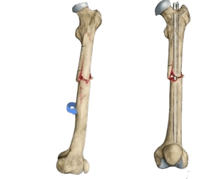 Internal Fixation of Fractures