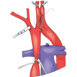 Interrupted Aortic Arch Surgery