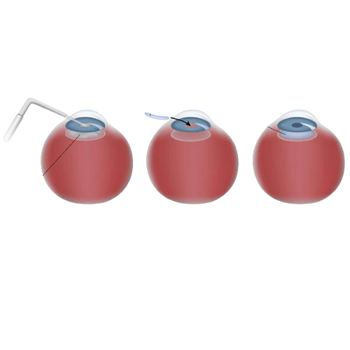 Intraocular Implants