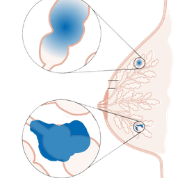 Invasive Lobular Carcinoma
