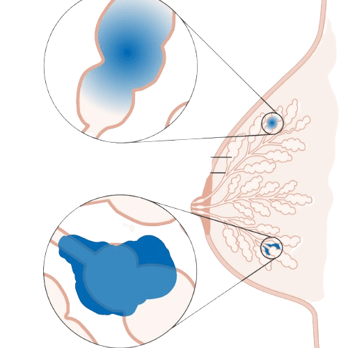 Invasive Lobular Carcinoma