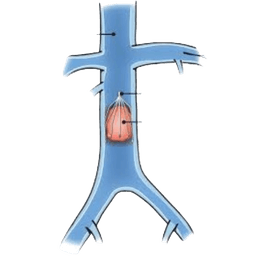 IVC Filter Insertion