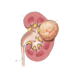 Kidney Cancer
