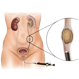 Kidney Stones Removal Surgery