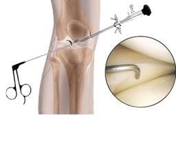 Knee Arthroscopy