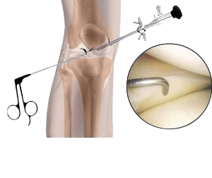 Knee Arthroscopy