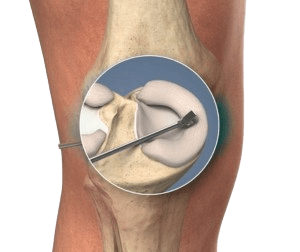 Knee Meniscectomy