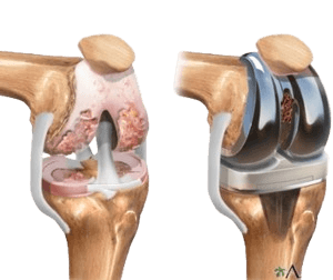Knee Replacement Surgery