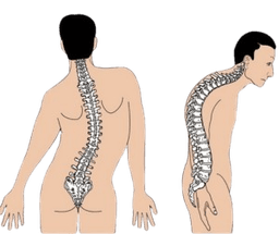 Kyphosis (hunchback)