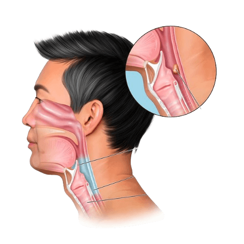 Laryngeal & Hypopharyngeal Cancer