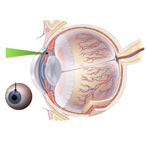 Laser Iridotomy