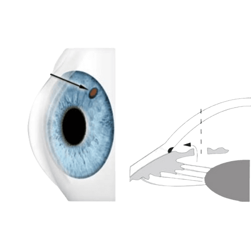 Laser Peripheral Iridotomy