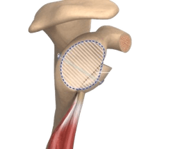 Latarjet Procedure