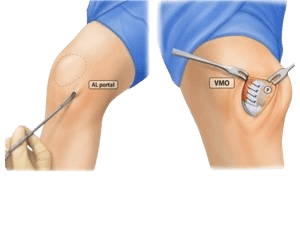 Lateral Retinacular Release Surgery
