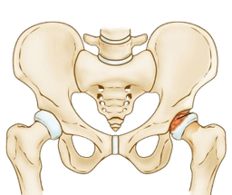 Legg Calve Perthes Disease-LCPD