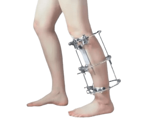 Limb Reconstruction Surgery