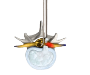 Lumbar Disc Microsurgery