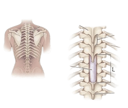 Lumbar Laminectomy for Spine