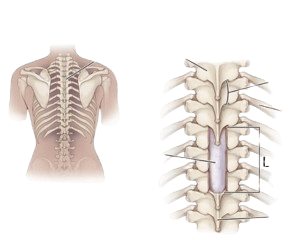 Lumbar Laminectomy for Spine